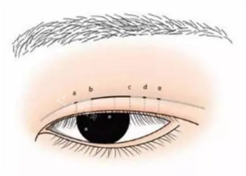 全切双眼皮示意图