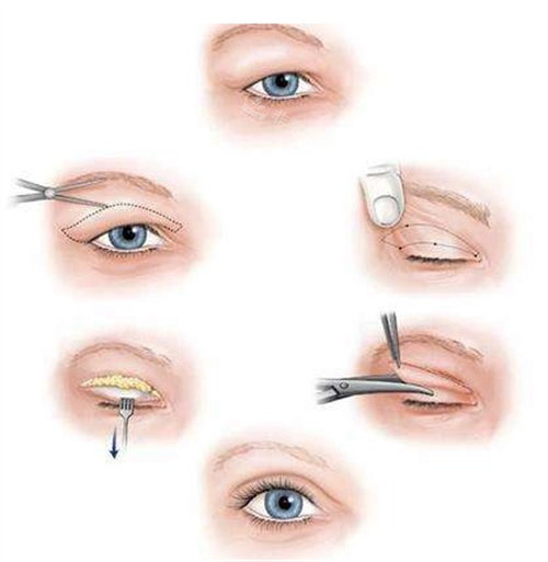 全切法双眼皮手术过程图