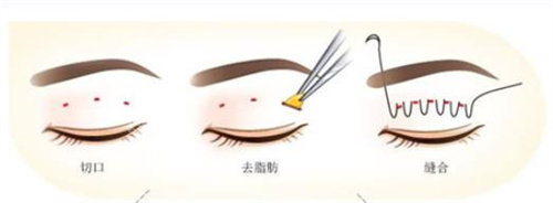 埋線雙眼皮過程圖 埋線雙眼皮過程圖