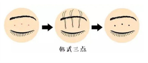 三点定位法双眼皮图片