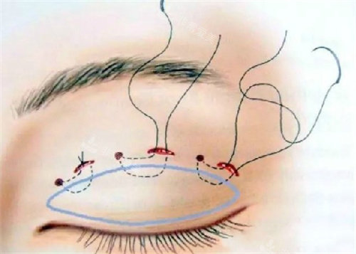 埋线双眼皮图片.jpg
