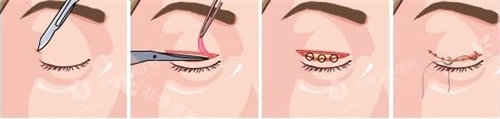 埋线双眼皮手术图.jpg