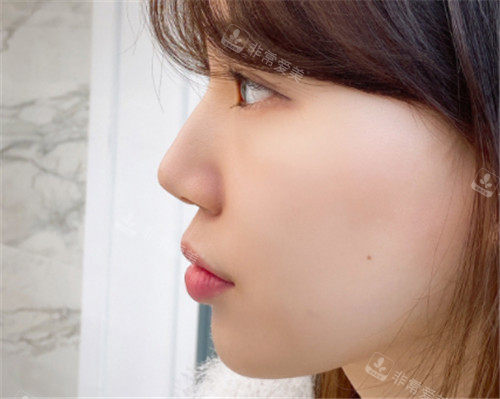 韩国优雅人做鼻子手术图