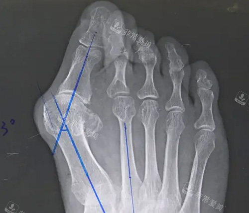 大腳骨拍攝ct照