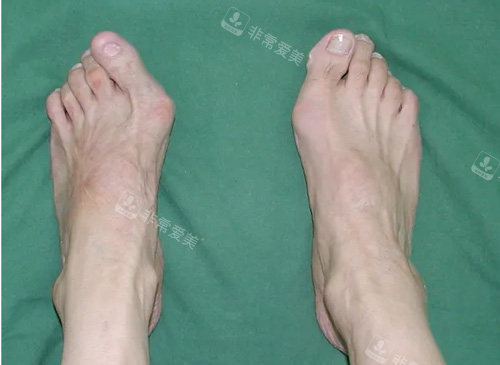 大腳骨畸形照片 大腳骨畸形照片