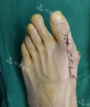 大腳骨整形術(shù)后照片 大腳骨整形術(shù)后照片
