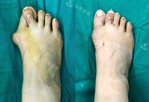 大腳骨矯正手術(shù)照片 大腳骨矯正手術(shù)照片