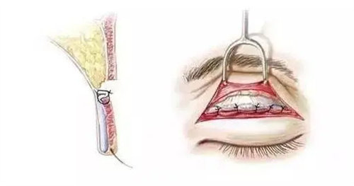 切開法雙眼皮動畫圖