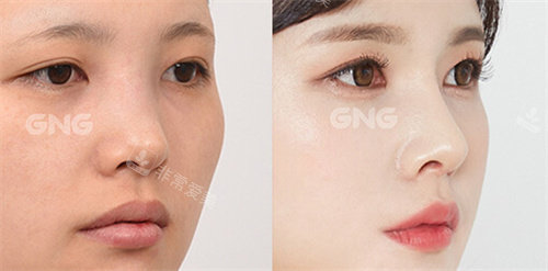 韩国GNG整形医院隆鼻对比图