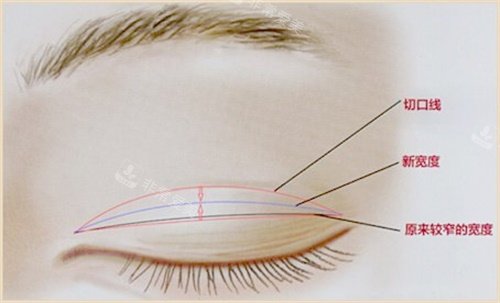 双眼皮修复示意图