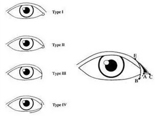 开眼角示意图.jpg