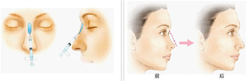 注射隆鼻前后對(duì)比圖 注射隆鼻前后對(duì)比圖
