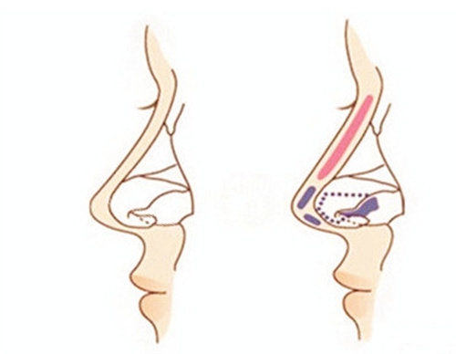 隆鼻架構(gòu)細(xì)節(jié)參考圖