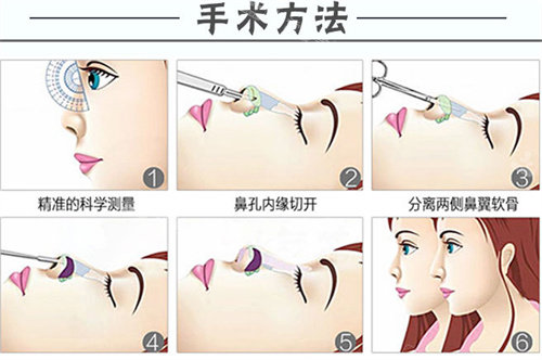 隆鼻手術(shù)方法圖 隆鼻手術(shù)方法圖