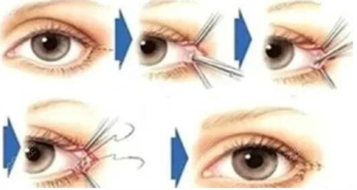 眼修復(fù)手術(shù)圖片.jpg 眼修復(fù)手術(shù)圖片.jpg