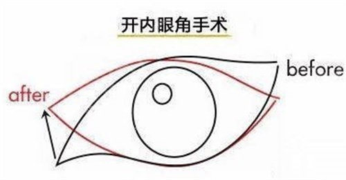 开眼角手术图.jpg 开眼角手术图.jpg