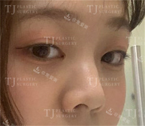 韩国TJ整形外科眼鼻整形术前照