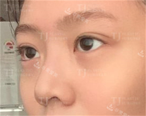 韩国TJ整形外科眼鼻整形例子图