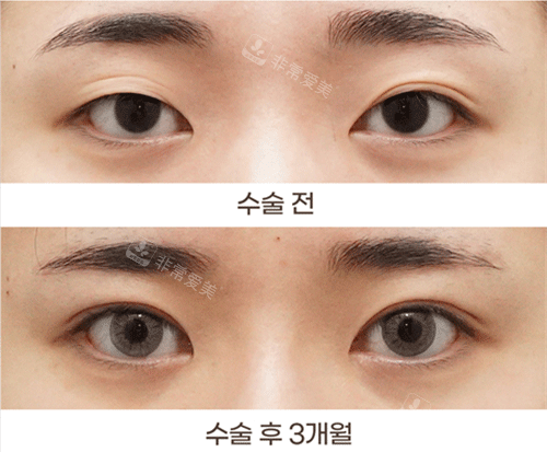 韩国THE BB整形外科眼部手术前后图