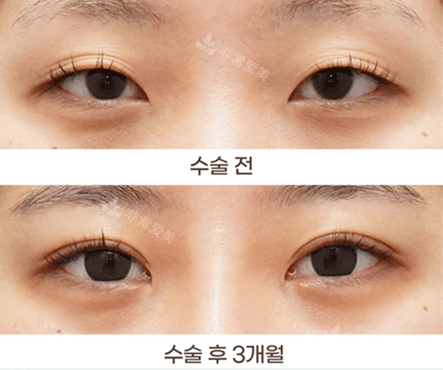 韓國得芘芘整形眼部整形前后圖 韓國得芘芘整形眼部整形前后圖