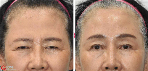 歌柔飛整形額頭提升手術(shù)前后 歌柔飛整形額頭提升手術(shù)前后