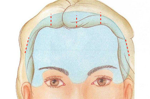 歌柔飛整形額頭提升手術(shù)切口位置圖