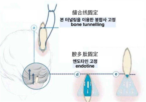 歌柔飞额头提升手术固定方式图解