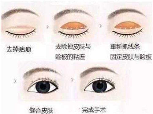 雙眼皮修復(fù)過(guò)程圖.jpg