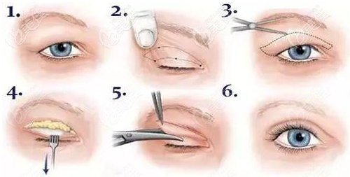 双眼皮手术过程图.jpg