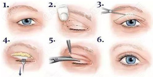 雙眼皮手術(shù)過程圖.jpg