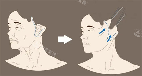 面部拉皮切口图