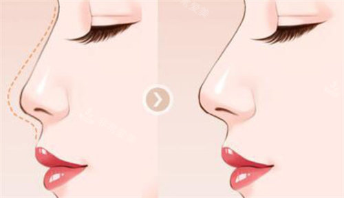 隆鼻方案设计动画图