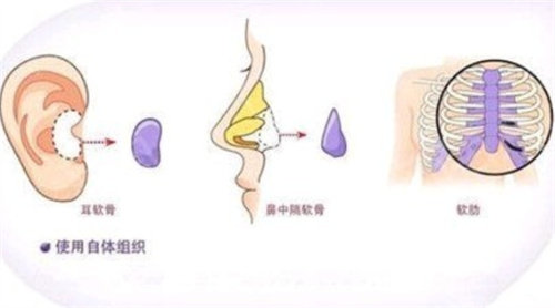 自體軟骨隆鼻操作圖