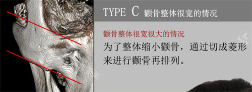 韓國現(xiàn)代整形外科顴骨整形圖示 韓國現(xiàn)代整形外科顴骨整形圖示
