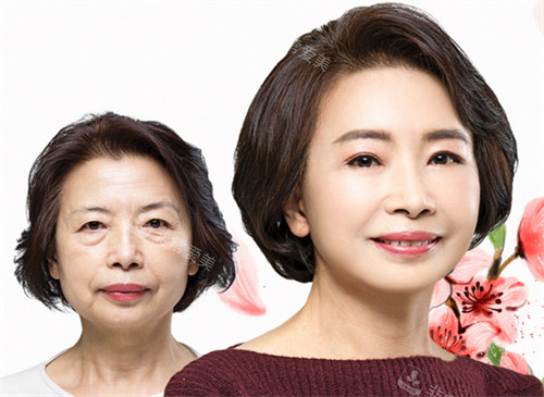 韩国卓佑炫整形外科拉皮手术对比照