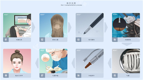 植发过程图示 植发过程图示