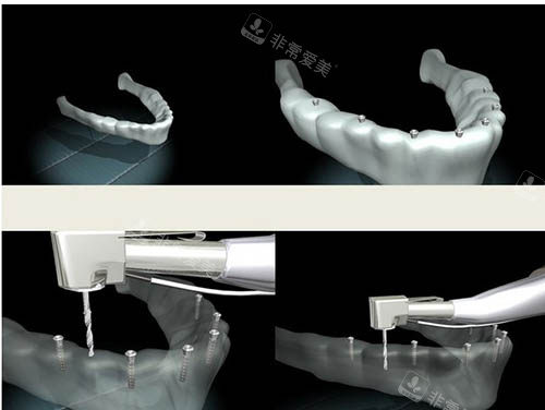 種植牙手術(shù)動畫步驟圖
