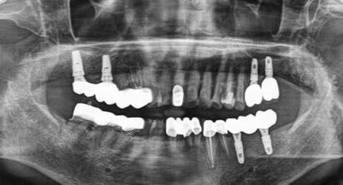 全口种植牙ct图