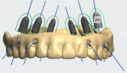 数字化种植牙设计图