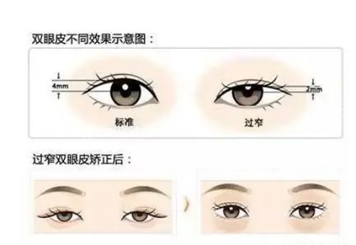 韩国DA整形双眼皮修复好吗？高难度眼修复可以做！