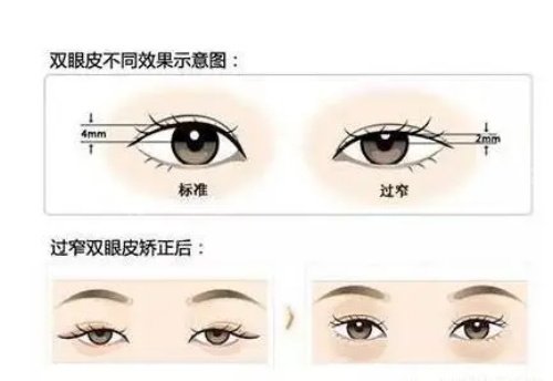 双眼皮矫正后示意图 双眼皮矫正后示意图