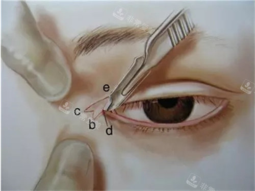 開內(nèi)眼角手術(shù)圖.jpg 開內(nèi)眼角手術(shù)圖.jpg