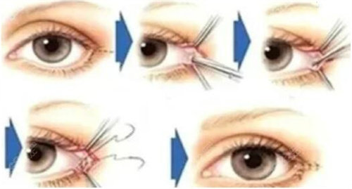 內(nèi)眼角修復(fù)圖.jpg 內(nèi)眼角修復(fù)圖.jpg