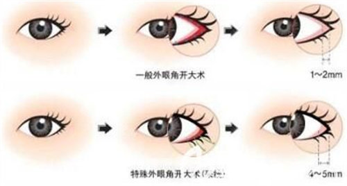 內(nèi)眼角操作圖.jpg 內(nèi)眼角操作圖.jpg
