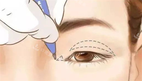 內(nèi)眼角示意圖.jpg 內(nèi)眼角示意圖.jpg