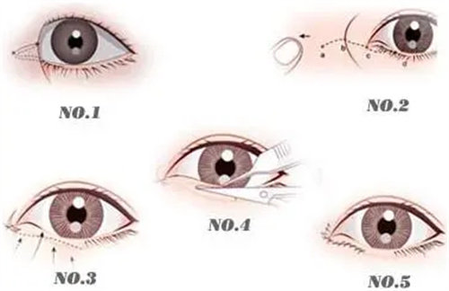 内眼角修复手术过程图.jpg