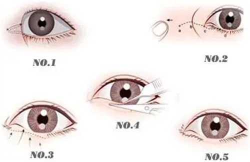 內(nèi)眼角修復(fù)手術(shù)過程圖.jpg 內(nèi)眼角修復(fù)手術(shù)過程圖.jpg