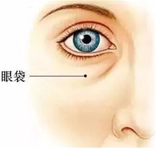 眼袋示意圖.jpg 眼袋示意圖.jpg