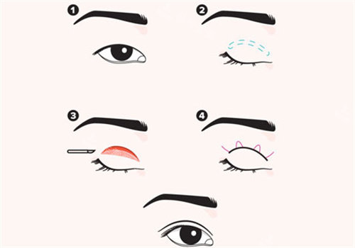 双眼皮手术操作过程图.jpg