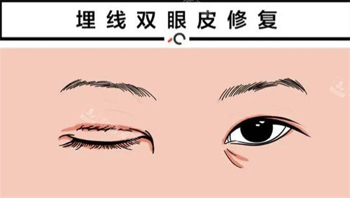 双眼皮修复动画展示图 双眼皮修复动画展示图